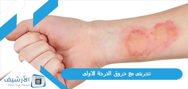 مع حروق الدرجة الاولى والعلاج السريع للحروق