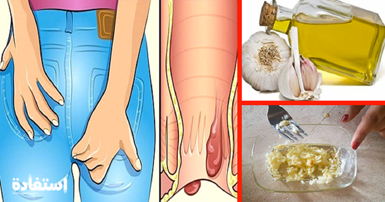 إزالة البواسير بدون عملية جراحية وبطرق طبيعية علاج البواسير