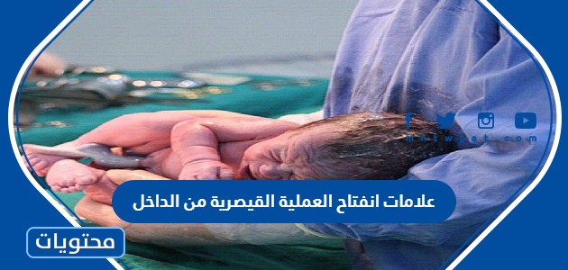 انفتاح العملية القيصرية من الداخل