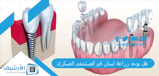 يوجد زراعة اسنان في المستشفى العسكري؟ افضل دكتور حشوات