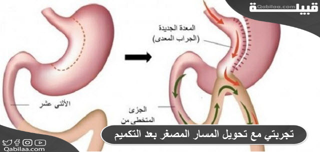 مع تحويل المسار المصغر بعد التكميم