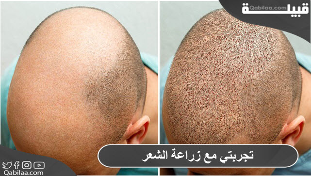 مع زراعة الشعر 1