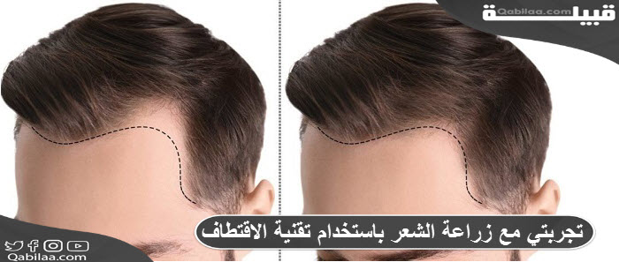 مع زراعة الشعر باستخدام تقنية الاقتطاف