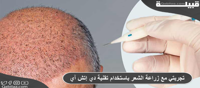 مع زراعة الشعر باستخدام تقنية دي إتش آي