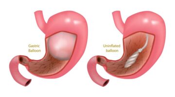 مع بالون المعدة ما هي الاثار الجانبية لبالون المعدة؟